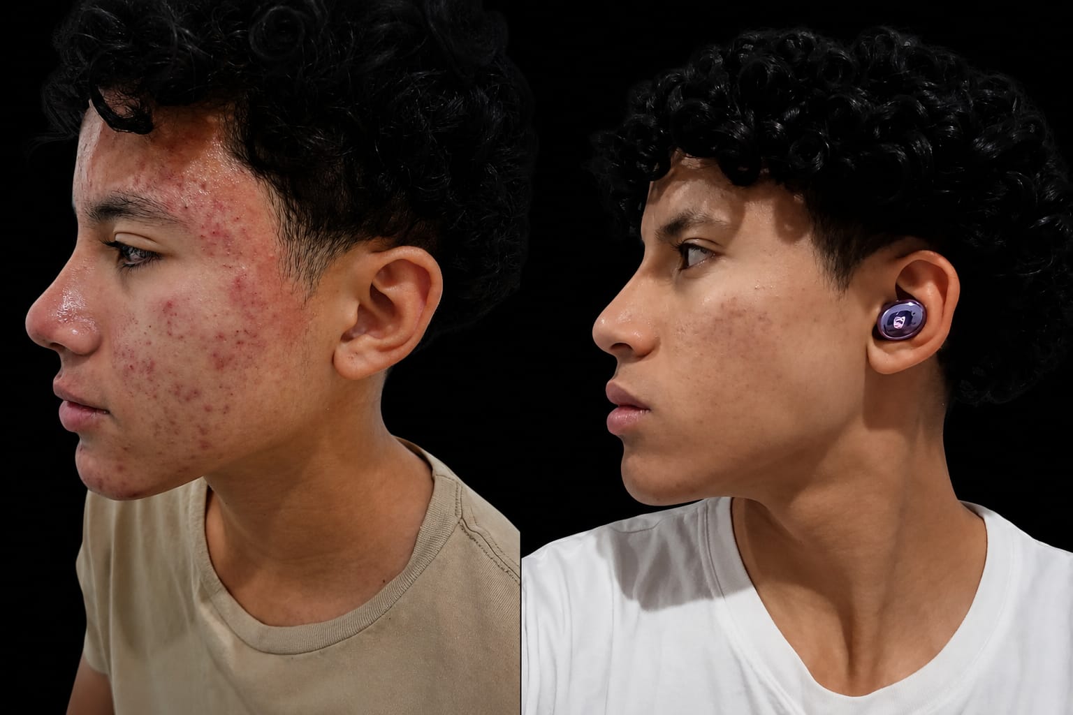 Tratamento para Pele Acneica